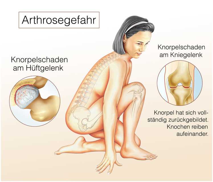  Effektive Methoden zur Schmerzlinderung bei Arthrose 