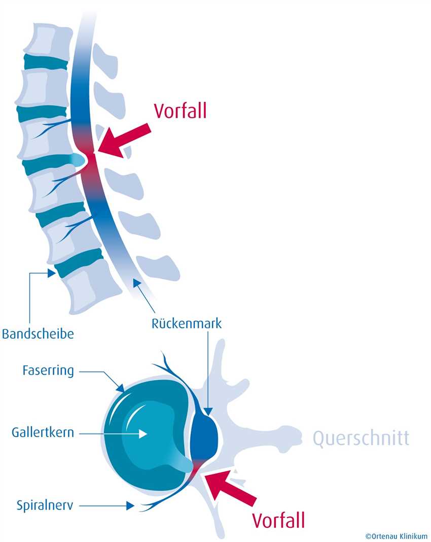 Rehabilitationsmaßnahmen nach der Bandscheiben-OP